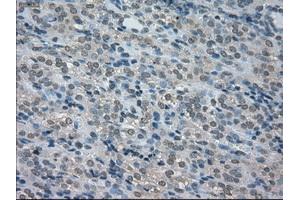 Immunohistochemical staining of paraffin-embedded Carcinoma of thyroid tissue using anti-BUB1Bmouse monoclonal antibody. (BUB1B antibody)