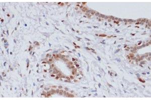 Immunohistochemistry of paraffin-embedded Human breast cancer using TriMethyl-Histone H3-K27 Polyclonal Antibody at dilution of 1:100 (40x lens). (Histone 3 antibody  (3meLys27))