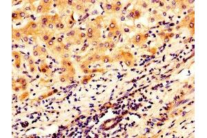 IHC image of ABIN7159817 diluted at 1:300 and staining in paraffin-embedded human liver cancer performed on a Leica BondTM system. (OGN antibody  (AA 21-298))