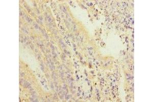 Immunohistochemistry of paraffin-embedded human colon cancer using ABIN7168417 at dilution of 1:100
