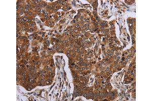 Immunohistochemistry of Human liver cancer using ACP6 Polyclonal Antibody at dilution of 1:30 (ACP6 antibody)
