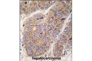 Formalin-fixed and paraffin-embedded human hepatocarcinoma tissue reacted with OA2 antibody (Center) 7422c , which was peroxidase-conjugated to the secondary antibody, followed by DAB staining. (APOA2 antibody  (AA 28-56))