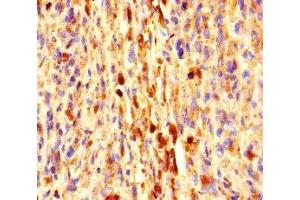 Immunohistochemistry of paraffin-embedded human melanoma using ABIN7152273 at dilution of 1:100