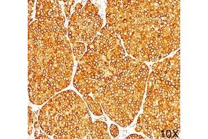 IHC staining of melanoma tissue (10X) with Tyrosinase antibody (T311). (TYR antibody)