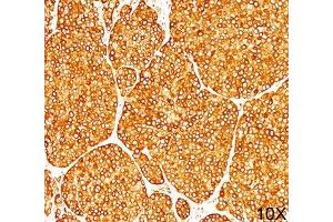 IHC staining of melanoma tissue (10X) with Tyrosinase antibody (T311). (TYR antibody)