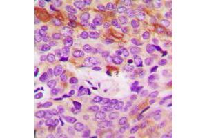 Immunohistochemical analysis of Collagen 4 alpha 5 staining in human breast cancer formalin fixed paraffin embedded tissue section. (COL4a5 antibody  (N-Term))