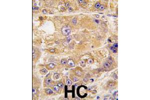 Formalin-fixed and paraffin-embedded human hepatocellular carcinoma reacted with LDLRAP1 polyclonal antibody  , which was peroxidase-conjugated to the secondary antibody, followed by DAB staining. (LDLRAP1 antibody  (C-Term))