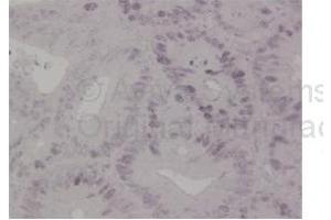 Sample Type: Human Colon Cancer Tissue Primary Dilution: 1ug/mL