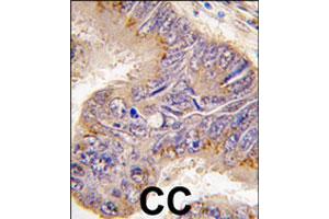 Formalin-fixed and paraffin-embedded human colon carcinoma tissue reacted with RPS6 polyclonal antibody  , which was peroxidase-conjugated to the secondary antibody, followed by DAB staining. (RPS6 antibody  (N-Term))