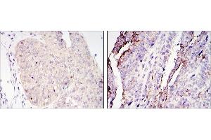 Immunohistochemical analysis of paraffin-embedded ovary tumour tissues (left) and lung cancer (right) using CRTC2 antibody with DAB staining.
