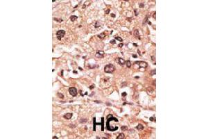Formalin-fixed and paraffin-embedded human hepatocellular carcinoma tissue reacted with MAGEF1 polyclonal antibody  , which was peroxidase-conjugated to the secondary antibody, followed by AEC staining. (MAGEF1 antibody  (C-Term))