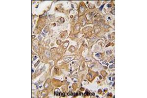 Formalin-fixed and paraffin-embedded human lung carcinoma tissue reacted with LECT1 antibody , which was peroxidase-conjugated to the secondary antibody, followed by DAB staining. (LECT1 antibody  (C-Term))
