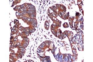 Immunohistochemical analysis of paraffin-embedded Colorectal cancer using BiP/GRP78 (C-terminus) Mouse mAb (1/100 dilution). (GRP78 antibody  (C-Term))