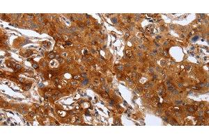 Immunohistochemistry of paraffin-embedded Human lung cancer using PLAUR Polyclonal Antibody at dilution of 1:60 (PLAUR antibody)