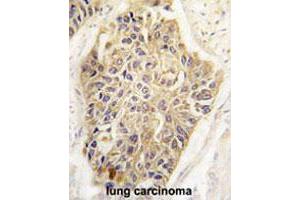 Formalin-fixed and paraffin-embedded human lung carcinoma tissue reacted with MAGEA1 polyclonal antibody  , which was peroxidase-conjugated to the secondary antibody, followed by DAB staining. (MAGEA1 antibody  (Internal Region))