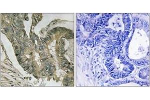 Immunohistochemistry analysis of paraffin-embedded human colon carcinoma tissue, using ALDOC Antibody.
