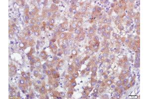 Paraformaldehyde-fixed, paraffin embedded human liver carcinoma tissue, Antigen retrieval by boiling in sodium citrate buffer(pH6) for 15min, Block endogenous peroxidase by 3% hydrogen peroxide for 30 minutes, Blocking buffer (normal goat serum) at 37°C for 20min, Antibody incubation with GPR110 Polyclonal Antibody, Unconjugated  at 1:500 overnight at 4°C, followed by a conjugated secondary and DAB staining (G Protein-Coupled Receptor 110 antibody  (AA 51-150))