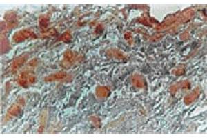 Immunhistochemical analysis in adipocytes of human breast carcinoma tissue using MKI67IP polyclonal antibody  at 1 : 500 dilution.