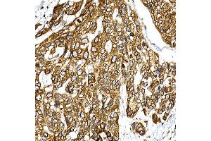 Immunohistochemistry of paraffin-embedded human esophageal cancer using VAPB Rabbit pAb (ABIN6132783, ABIN6150058, ABIN6150059 and ABIN6221003) at dilution of 1:50 (40x lens).