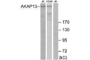 Immunohistochemistry analysis of paraffin-embedded human lung carcinoma tissue using AKAP13 antibody.