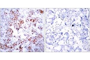 Immunohistochemistry analysis of paraffin-embedded human breast carcinoma tissue, using ATF2 (Ab-69 or 51) Antibody.
