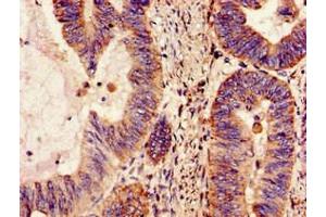 Immunohistochemistry of paraffin-embedded human colon cancer using ABIN7160959 at dilution of 1:100 (NDUFS4 antibody  (AA 43-161))