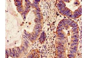 Immunohistochemistry of paraffin-embedded human colon cancer using ABIN7160959 at dilution of 1:100