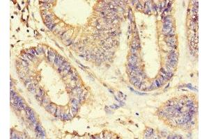 Immunohistochemistry of paraffin-embedded human endometrial cancer using ABIN7143597 at dilution of 1:100 (ASIP antibody  (AA 23-112))