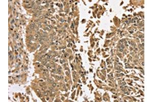 The image on the left is immunohistochemistry of paraffin-embedded Human lung cancer tissue using (TGM6 Antibody) at dilution 1/35, on the right is treated with synthetic peptide. (TGM6 antibody)