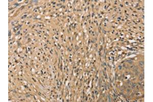 The image on the left is immunohistochemistry of paraffin-embedded Human cervical cancer tissue using ABIN7131042(SETD2 Antibody) at dilution 1/40, on the right is treated with fusion protein. (SETD2 antibody)
