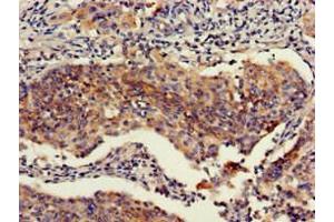 Immunohistochemistry of paraffin-embedded human cervical cancer using ABIN7151111 at dilution of 1:100 (RBBP6 antibody  (AA 51-97))