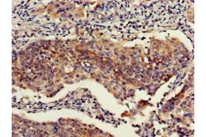Immunohistochemistry of paraffin-embedded human cervical cancer using ABIN7151111 at dilution of 1:100