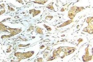 Immunohistochemistry (IHC) analyzes of STAT1 antibody in paraffin-embedded human breast carcinoma tissue. (STAT1 antibody)