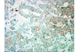 IHC-P Image Immunohistochemical analysis of paraffin-embedded Human Breast Cancer, using PI3 kinase p110 alpha, antibody. (PIK3CA antibody  (N-Term))