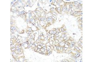 Immunohistochemistry of paraffin-embedded Human lung cancer using ATP1B1 Polyclonal Antibody at dilution of 1:100 (40x lens). (ATP1B1 antibody)