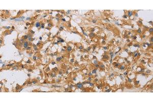 Immunohistochemistry of paraffin-embedded Human thyroid cancer tissue using RAD54L2 Polyclonal Antibody at dilution 1:40