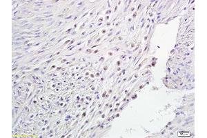 Formalin-fixed and paraffin embedded human endometrial cancer labeled with Anti-Notch1/MOTC Polyclonal Antibody, Unconjugated (ABIN675114) followed by conjugation to the secondary antibody and DAB staining