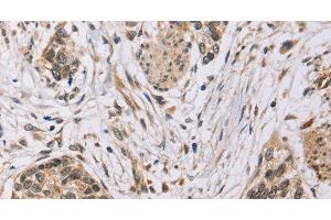 Immunohistochemistry of paraffin-embedded Human esophagus cancer tissue using PDLIM7 Polyclonal Antibody at dilution 1:35