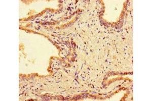 Immunohistochemistry of paraffin-embedded human prostate cancer using ABIN7165948 at dilution of 1:100 (PPM1H antibody  (AA 73-289))