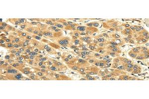 Immunohistochemistry of paraffin-embedded Human liver cancer tissue using UACA Polyclonal Antibody at dilution 1:45 (UACA antibody)