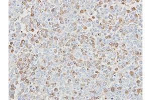 IHC-P Image Immunohistochemical analysis of paraffin-embedded TOV-112D xenograft, using USP5, antibody at 1:500 dilution. (USP5 antibody)