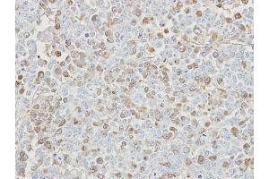 IHC-P Image Immunohistochemical analysis of paraffin-embedded TOV-112D xenograft, using USP5, antibody at 1:500 dilution.
