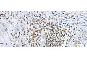 Immunohistochemistry of paraffin-embedded Human liver cancer tissue using DHRS7B Polyclonal Antibody at dilution of 1:80(x200) (DHRS7B antibody)