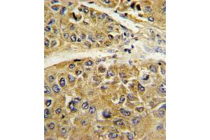 Formalin-fixed and paraffin-embedded human hepatocarcinoma reacted with SERPINA7 Antibody , which was peroxidase-conjugated to the secondary antibody, followed by DAB staining. (SERPINA7 antibody  (C-Term))