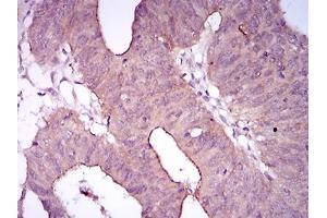 Immunohistochemical analysis of paraffin-embedded rectum cancer tissues using ITGA2B mouse mAb with DAB staining. (Integrin Alpha2b antibody  (AA 45-149))