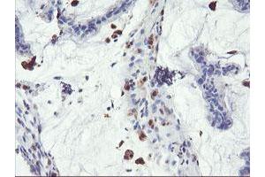 Immunohistochemical staining of paraffin-embedded Adenocarcinoma of Human colon tissue using anti-SDS mouse monoclonal antibody. (serine Dehydratase antibody)