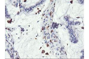 Immunohistochemical staining of paraffin-embedded Adenocarcinoma of Human colon tissue using anti-SDS mouse monoclonal antibody.