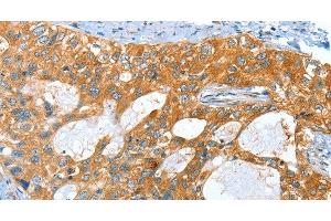 Immunohistochemistry of paraffin-embedded Human cervical cancer tissue using AMHR2 Polyclonal Antibody at dilution 1:40 (AMHR2 antibody)