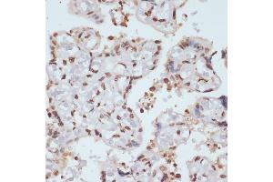 Immunohistochemistry of paraffin-embedded human placenta using Phospho-Chk1-S280 antibody (ABIN3019445, ABIN3019446, ABIN3019447 and ABIN6225372) at dilution of 1:100 (40x lens). (CHEK1 antibody  (pSer280))