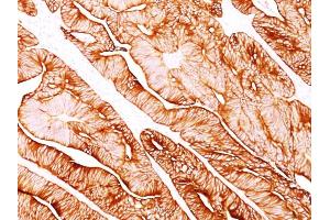 Formalin-fixed, paraffin-embedded human Colon Carcinoma stained with Cytokeratin 8 Mouse Monoclonal Antibody (H1). (KRT8 antibody)